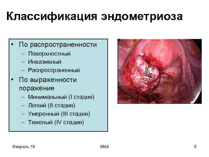 Классификация эндометриоза • По распространенности – Поверхностный – Инвазивный – Распространенный • По выраженности