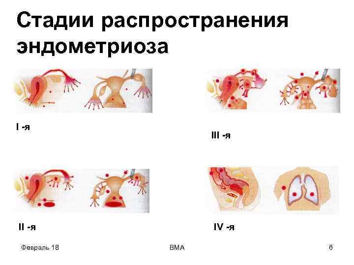 Стадии распространения эндометриоза I -я II -я Февраль 18 IV -я ВМА 6 