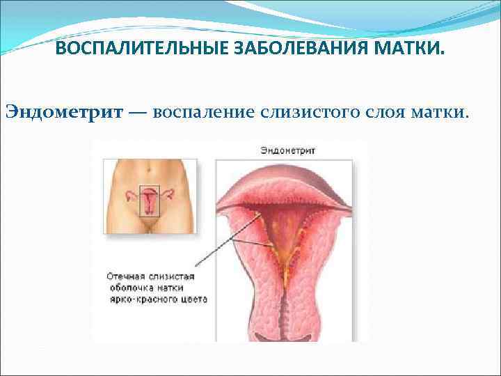 ВОСПАЛИТЕЛЬНЫЕ ЗАБОЛЕВАНИЯ МАТКИ. Эндометрит — воспаление слизистого слоя матки. 