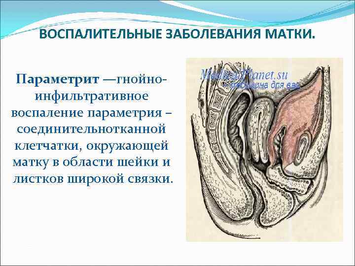 ВОСПАЛИТЕЛЬНЫЕ ЗАБОЛЕВАНИЯ МАТКИ. Параметрит —гнойноинфильтративное воспаление параметрия – соединительнотканной клетчатки, окружающей матку в области