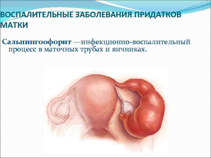 ВОСПАЛИТЕЛЬНЫЕ ЗАБОЛЕВАНИЯ ПРИДАТКОВ МАТКИ Сальпингоофорит —инфекционно-воспалительный процесс в маточных трубах и яичниках. 