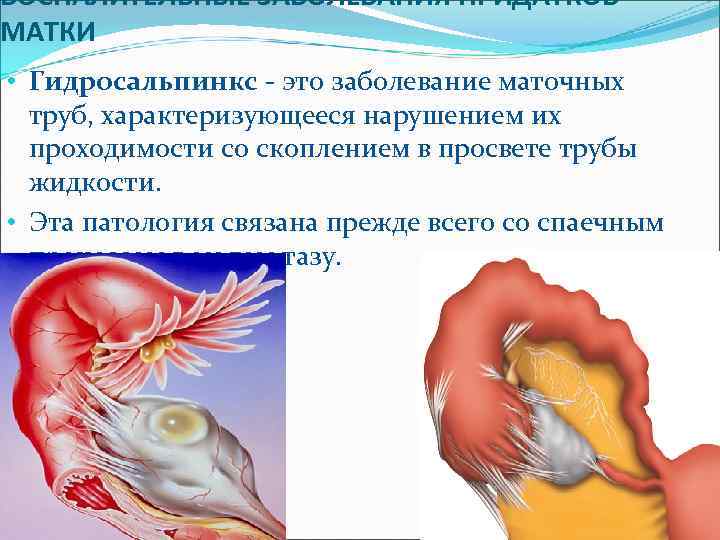 ВОСПАЛИТЕЛЬНЫЕ ЗАБОЛЕВАНИЯ ПРИДАТКОВ МАТКИ • Гидросальпинкс - это заболевание маточных труб, характеризующееся нарушением их