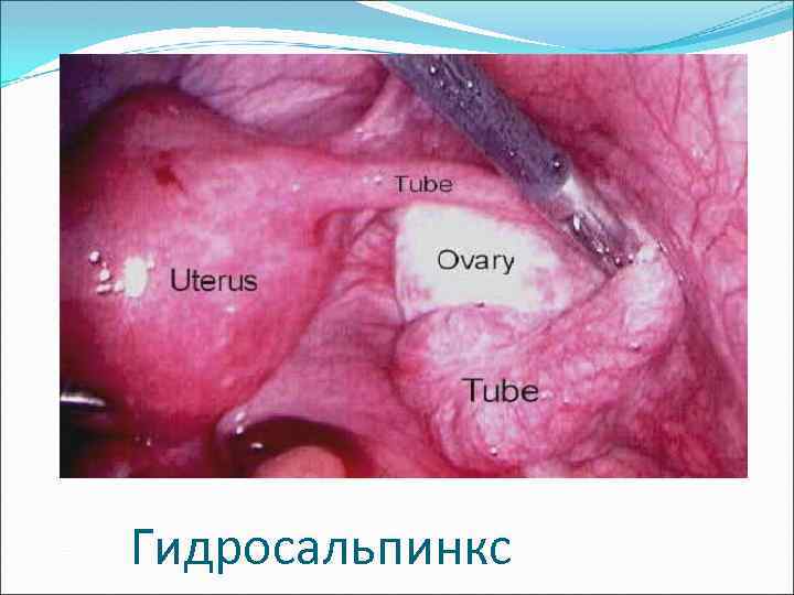 Гидросальпинкс 