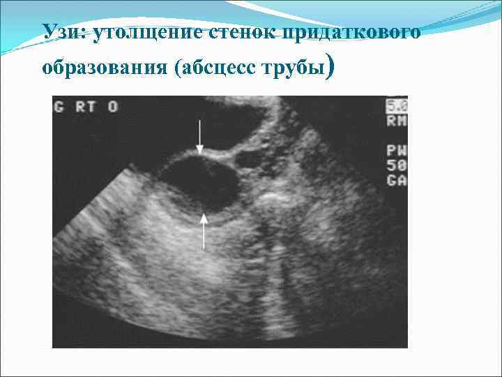 Узи: утолщение стенок придаткового образования (абсцесс трубы) 