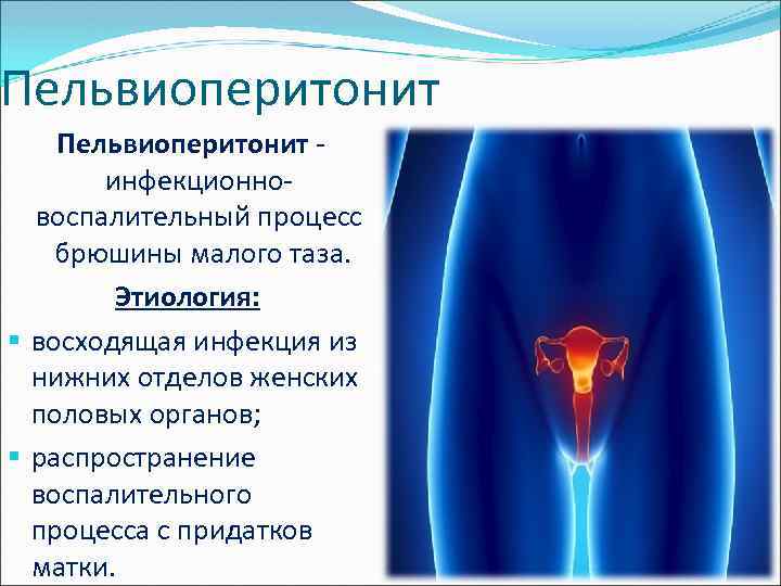 Пельвиоперитонит - инфекционновоспалительный процесс брюшины малого таза. Этиология: § восходящая инфекция из нижних отделов