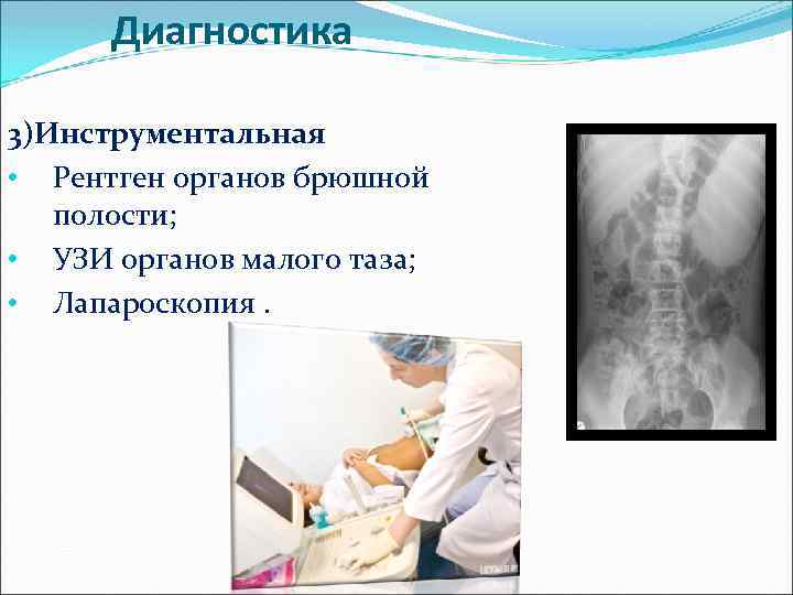 Диагностика 3)Инструментальная • Рентген органов брюшной полости; • УЗИ органов малого таза; • Лапароскопия.