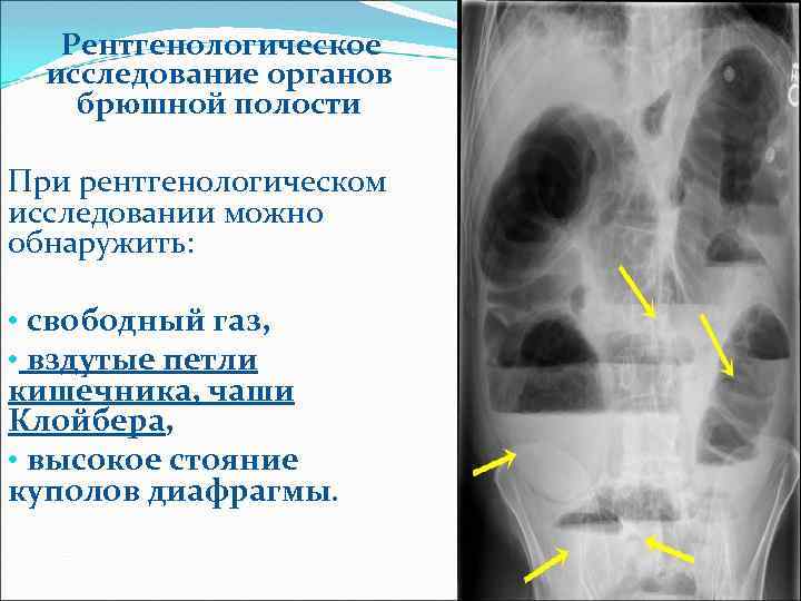 Рентгенологическое исследование органов брюшной полости При рентгенологическом исследовании можно обнаружить: • свободный газ, •