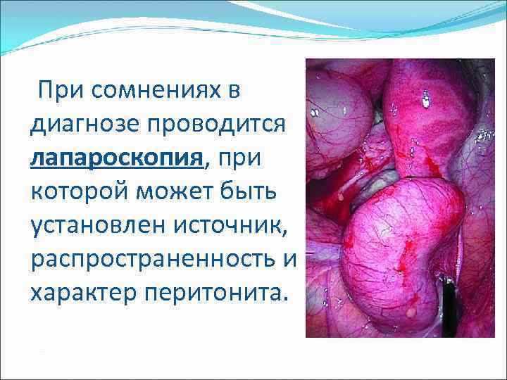  При сомнениях в диагнозе проводится лапароскопия, при которой может быть установлен источник, распространенность