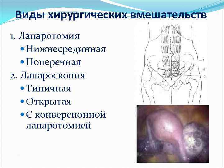 Виды хирургических вмешательств 1. Лапаротомия Нижнесрединная Поперечная 2. Лапароскопия Типичная Открытая С конверсионной лапаротомией