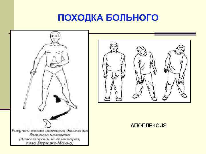 Походка больного. Типы походок. Атактическая походка. Спастикоатактическая походка это.