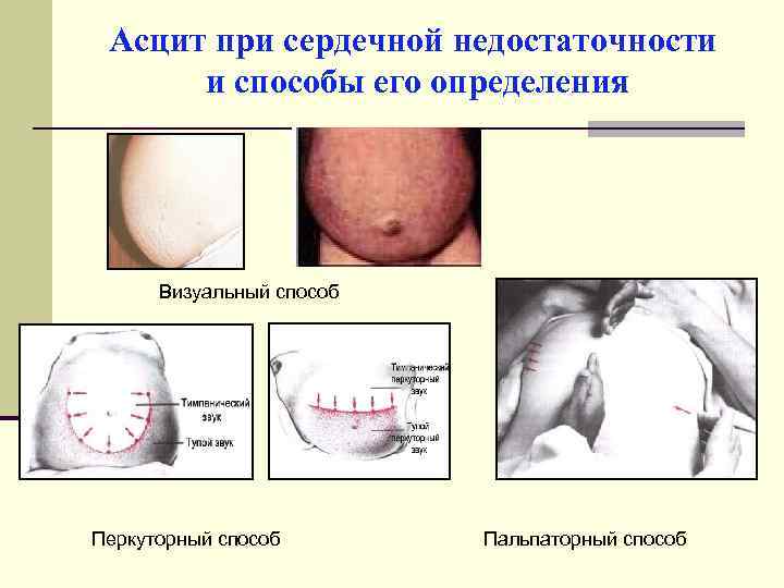 Асцит при сердечной недостаточности и способы его определения Визуальный способ Перкуторный способ Пальпаторный способ