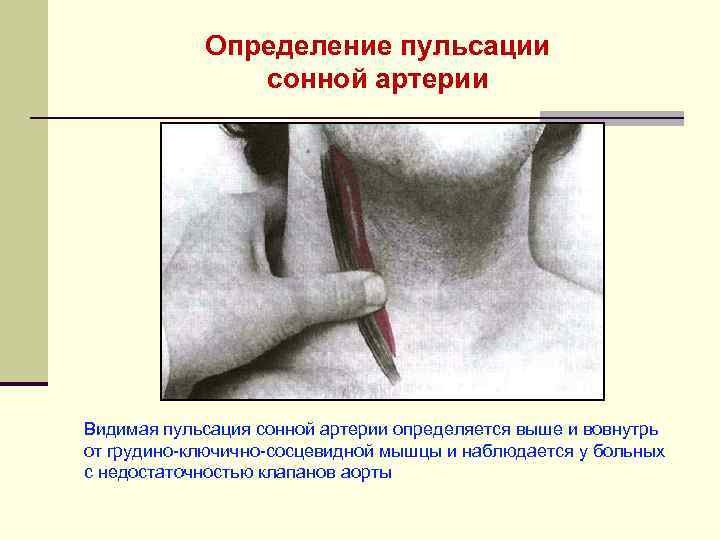Определение пульсации сонной артерии Видимая пульсация сонной артерии определяется выше и вовнутрь от грудино-ключично-сосцевидной
