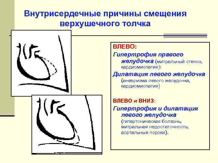 Гипертрофия и дилатация левого желудочка