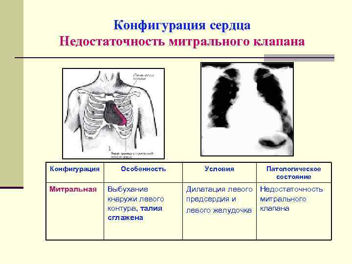 Недостаточность митрального клапана сердца