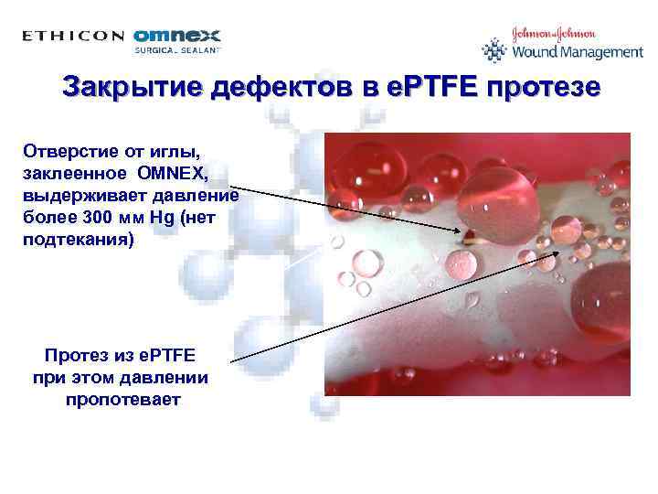 Закрытие дефектов в е. PTFE протезе Отверстие от иглы, заклеенное OMNEX, выдерживает давление более