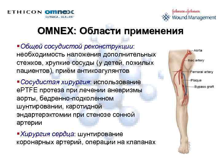 OMNEX: Области применения §Общей сосудистой реконструкции: необходимость наложения дополнительных стежков, хрупкие сосуды (у детей,