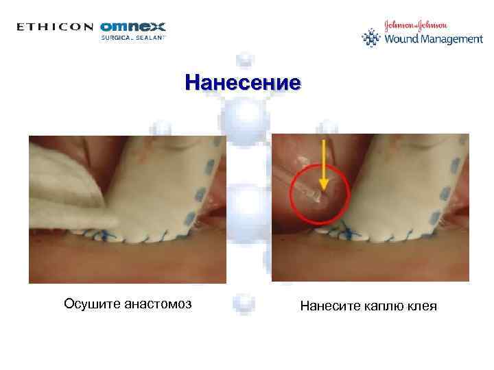 Нанесение Осушите анастомоз Нанесите каплю клея 