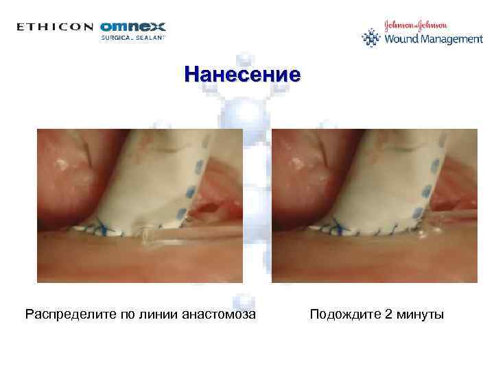 Нанесение Распределите по линии анастомоза Подождите 2 минуты 