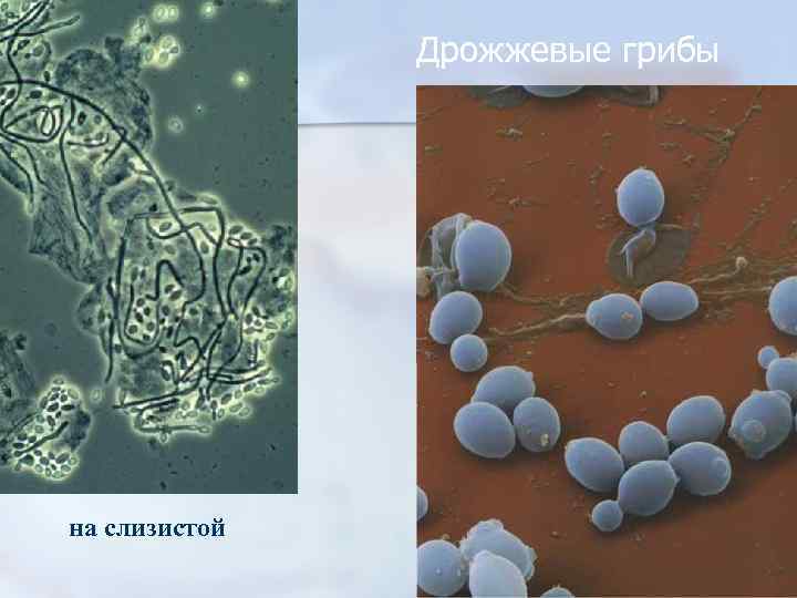 Дрожжевые грибы на слизистой 