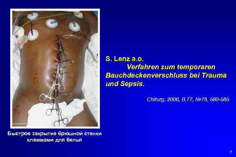 S. Lenz a. o. Verfahren zum temporaren Bauchdeckenverschluss bei Trauma und Sepsis. Chirurg, 2006,