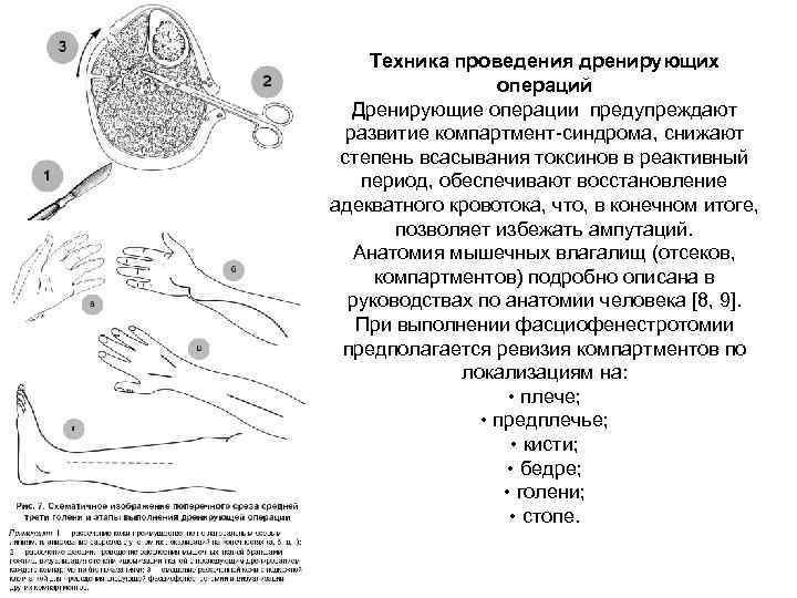 Техника проведения дренирующих операций Дренирующие операции предупреждают развитие компартмент-синдрома, снижают степень всасывания токсинов в