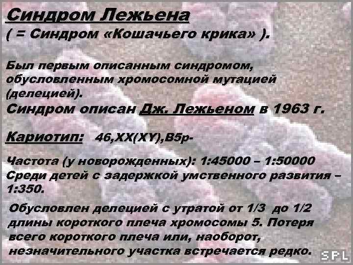 Синдром Лежьена ( = Синдром «Кошачьего крика» ). Был первым описанным синдромом, обусловленным хромосомной