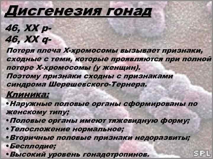 Дисгенезия гонад 46, ХХ р46, ХХ q- Потеря плеча Х-хромосомы вызывает признаки, сходные с