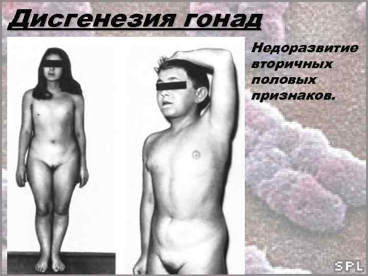 Дисгенезия гонад Недоразвитие вторичных половых признаков. 
