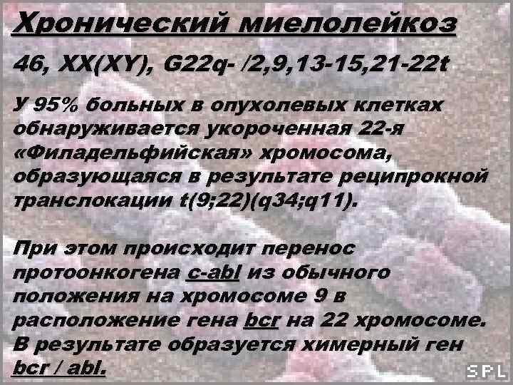 Хронический миелолейкоз 46, ХХ(ХY), G 22 q- /2, 9, 13 -15, 21 -22 t