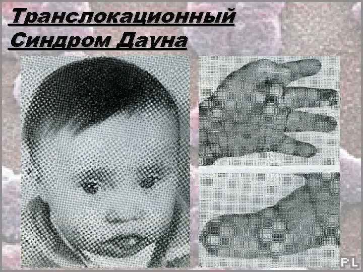 Транслокационный Синдром Дауна 