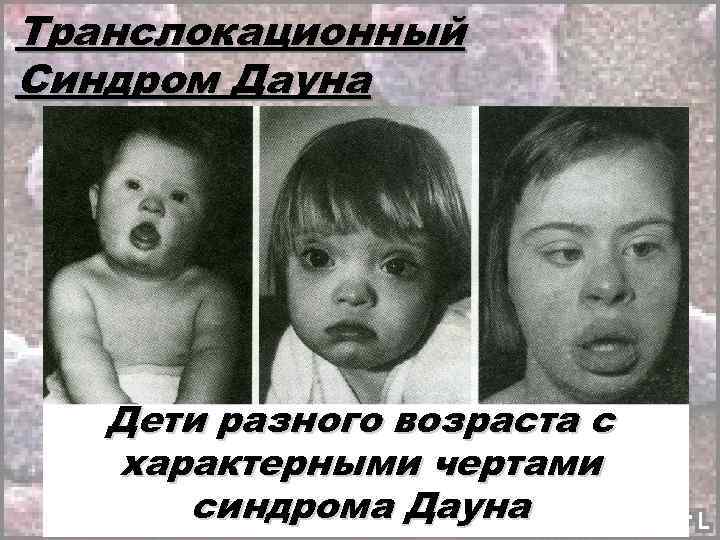 Транслокационный Синдром Дауна Дети разного возраста с характерными чертами синдрома Дауна 