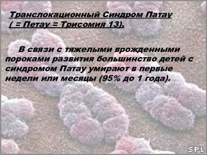 Транслокационный Синдром Патау ( = Петау = Трисомия 13). В связи с тяжелыми врожденными