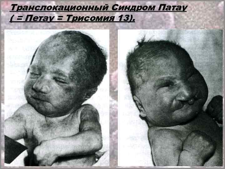 Транслокационный Синдром Патау ( = Петау = Трисомия 13). 