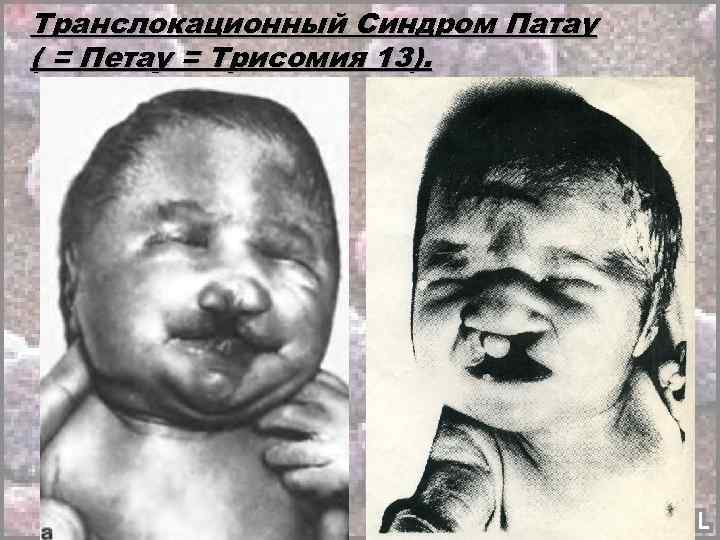 Транслокационный Синдром Патау ( = Петау = Трисомия 13). 