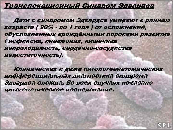 Транслокационный Синдром Эдвардса Дети с синдромом Эдвардса умирают в раннем возрасте ( 90% -