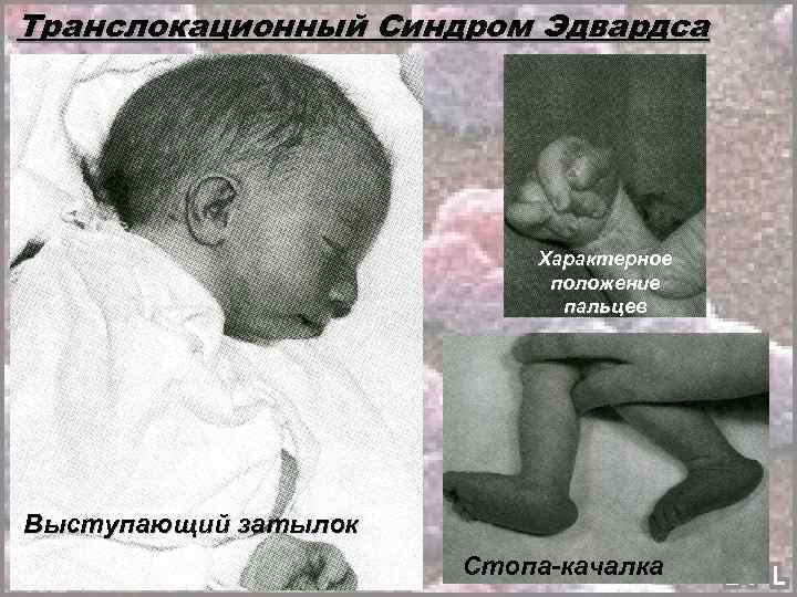 Транслокационный Синдром Эдвардса Характерное положение пальцев Выступающий затылок Стопа-качалка 