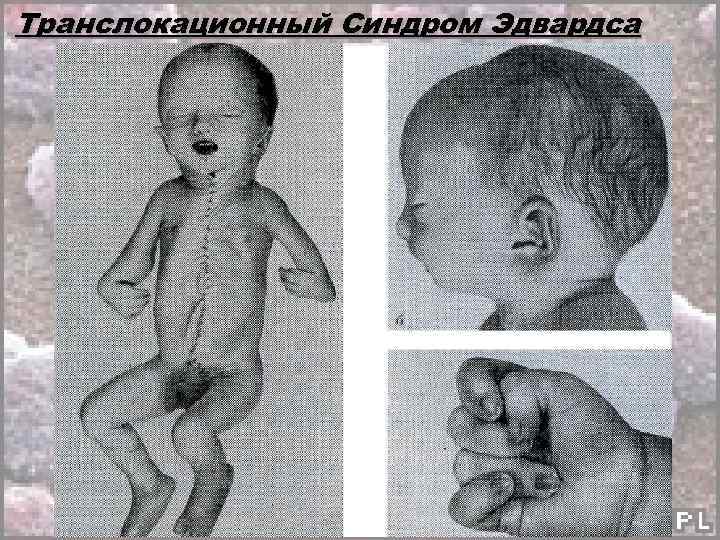 Транслокационный Синдром Эдвардса 
