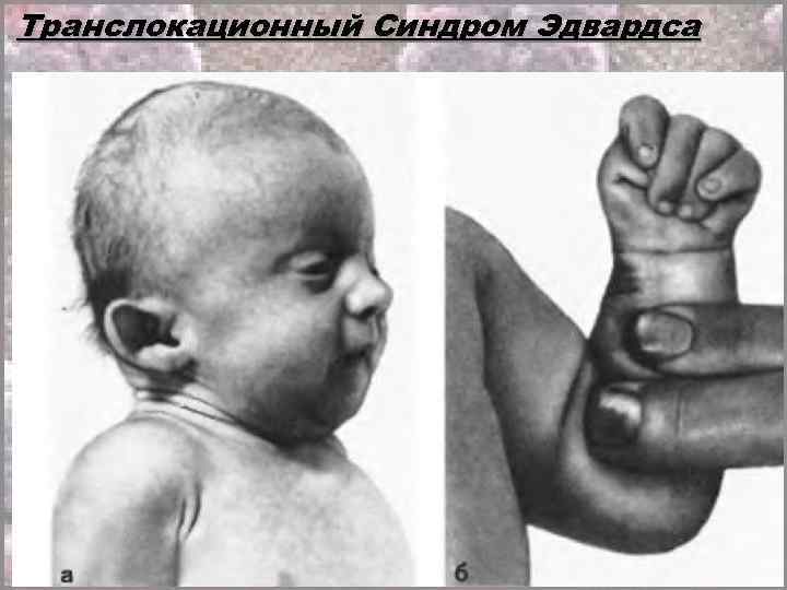 Транслокационный Синдром Эдвардса 