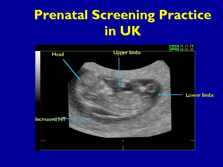 Prenatal Screening Practice in UK Head Upper limbs Lower limbs Increased NT 