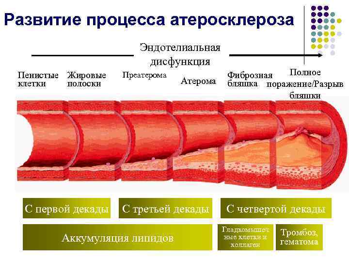 Развитие процесса атеросклероза Эндотелиальная дисфункция Пенистые Жировые клетки полоски С первой декады Преатерома Атерома