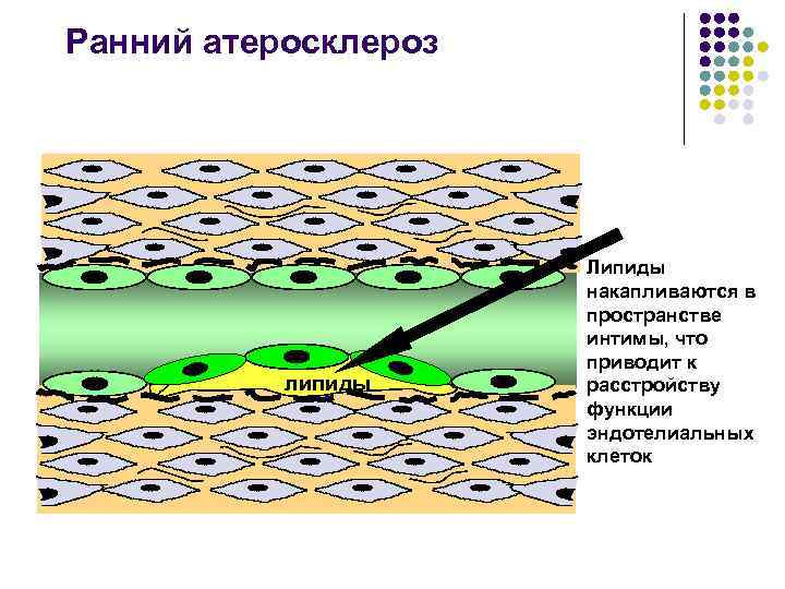 Ранний атеросклероз липиды Липиды накапливаются в пространстве интимы, что приводит к расстройству функции эндотелиальных