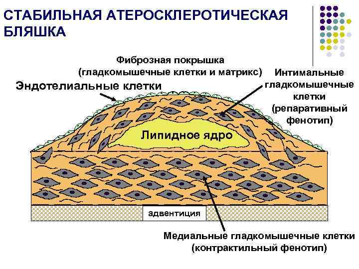 СТАБИЛЬНАЯ АТЕРОСКЛЕРОТИЧЕСКАЯ БЛЯШКА Фиброзная покрышка (гладкомышечные клетки и матрикс) Эндотелиальные клетки Интимальные гладкомышечные клетки