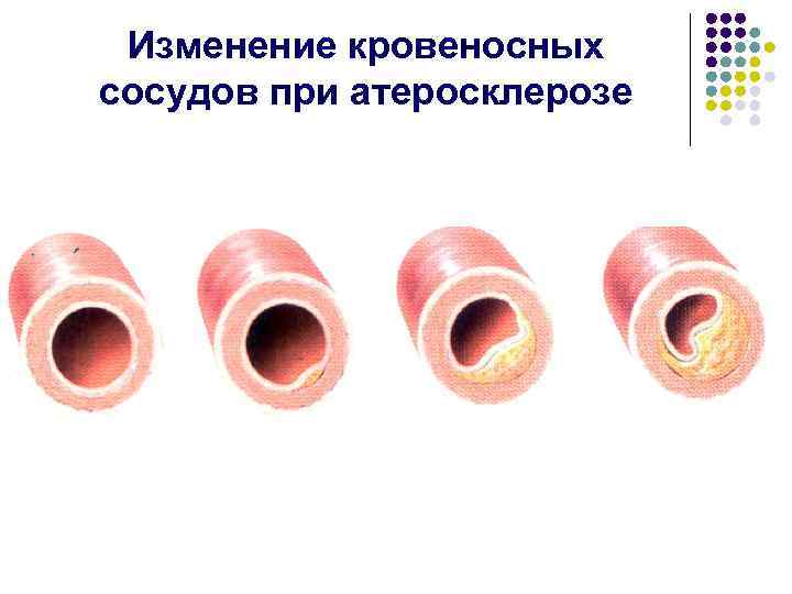 Изменение кровеносных сосудов при атеросклерозе 