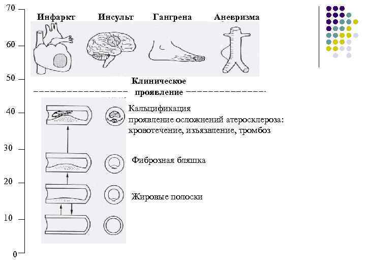 70 Инфаркт Инсульт Гангрена Аневризма 60 50 40 Клиническое проявление Кальцификация проявление осложнений атеросклероза: