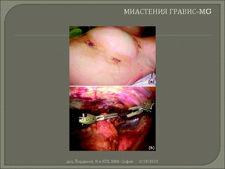 МИАСТЕНИЯ ГРАВИС-MG доц. Йорданов, Н-к КГХ, ВМА- София 3/15/2018 