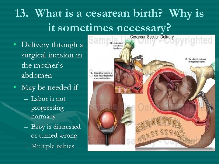 13. What is a cesarean birth? Why is it sometimes necessary? • Delivery through