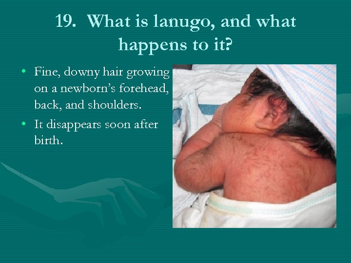 19. What is lanugo, and what happens to it? • Fine, downy hair growing