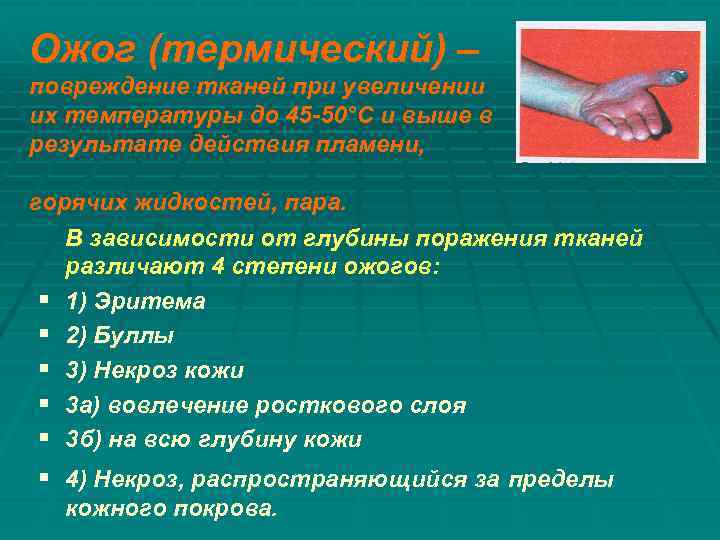 Ожог (термический) – повреждение тканей при увеличении их температуры до 45 -50°С и выше
