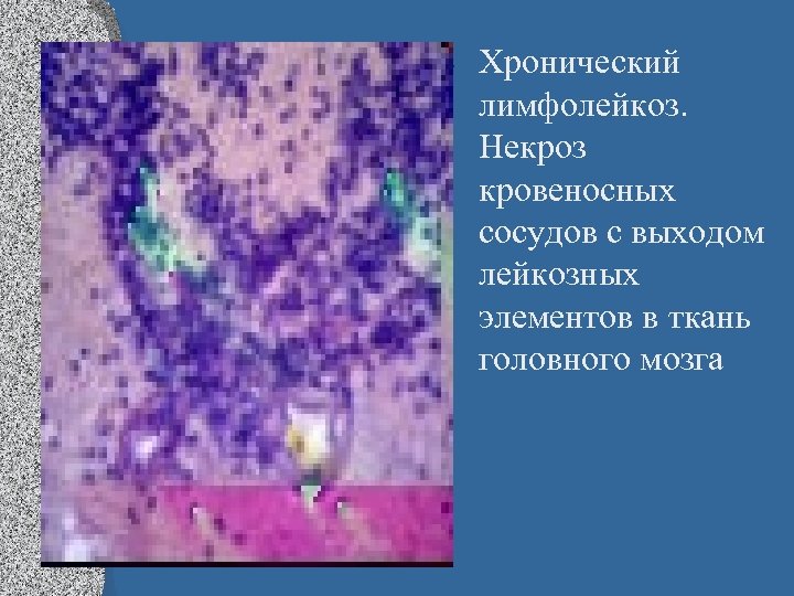  • Хронический лимфолейкоз. Некроз кровеносных сосудов с выходом лейкозных элементов в ткань головного