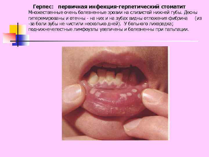 Герпес: первичная инфекция-герпетический стоматит Множественные очень болезненные эрозии на слизистой нижней губы. Десны гиперемированы